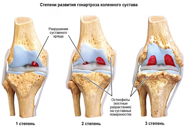 Деформирующий артроз